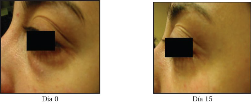 contorno de ojos