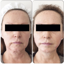 antes-despues